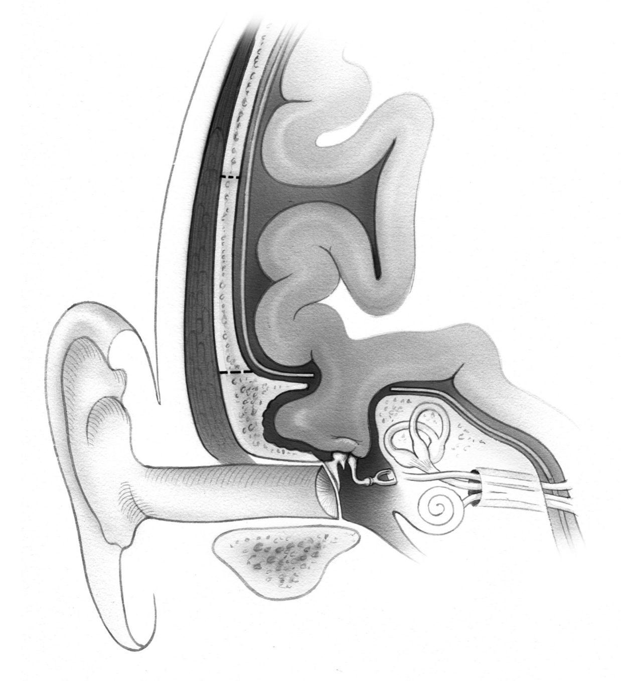 Encephalocele